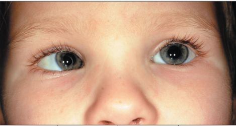 Amblyopia in the Young Generation