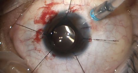 The Best Cataract Surgery