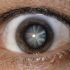 Cataracts