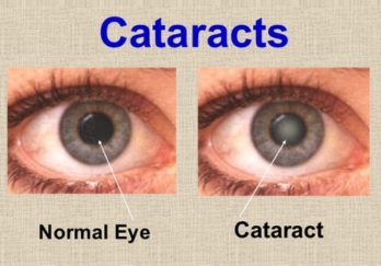 Cataract