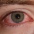 Conjunctivitis