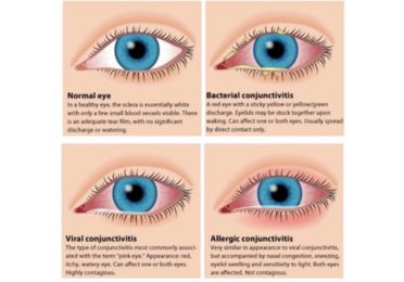 Conjunctival Conditions