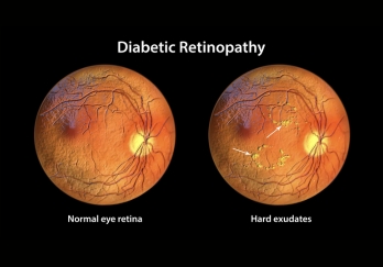 Diabetic Retinopathy