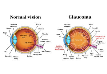 Glaucoma