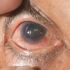 Glaucoma Silent Thief