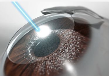 LASIK Services