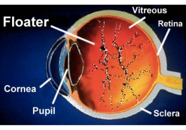 Macular Pucker