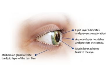 Dry Eye (MGD)