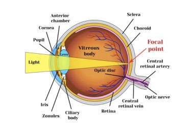 Refractive Errors