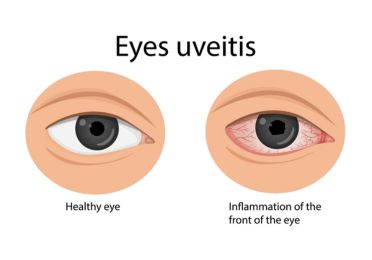 Uveitis